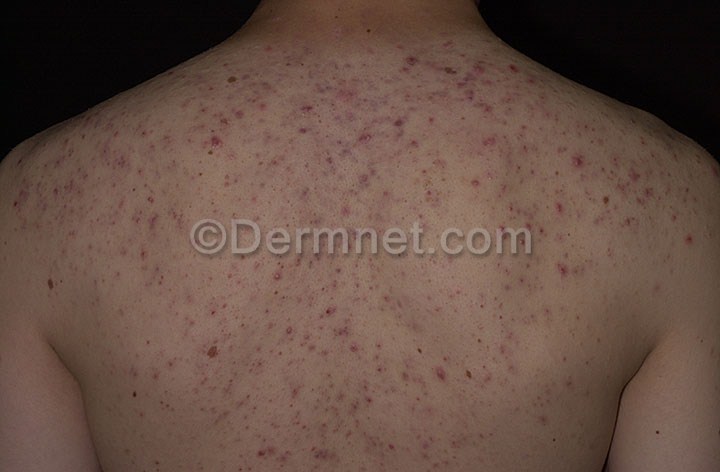 Image sample of the 626 Skin Diseases & 21K Skin Disorders Images Data: Skin Disease database