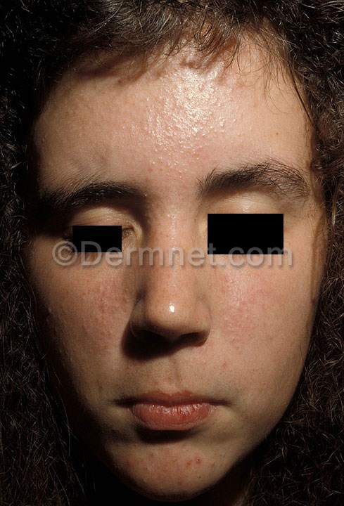Image sample of the 626 Skin Diseases & 21K Skin Disorders Images Data: Skin Disease database